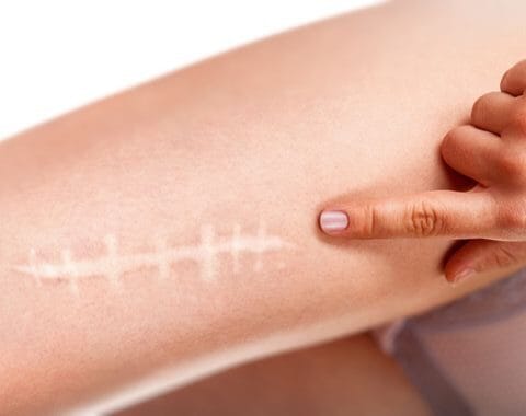 laser for acne scars