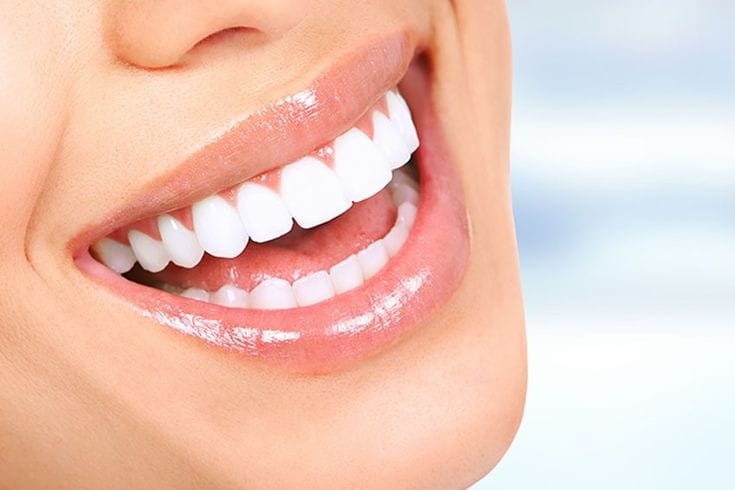 laser teeth whitening