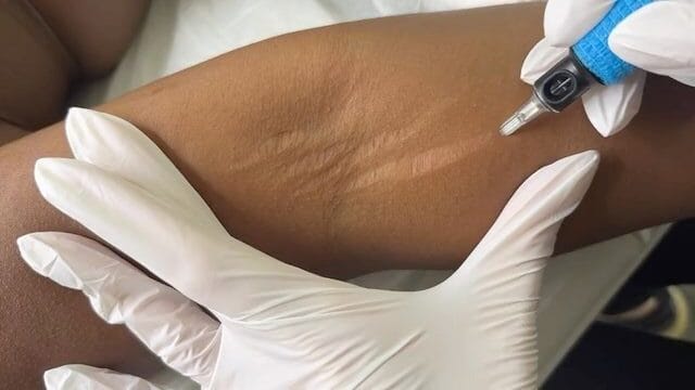 scars laser treatment