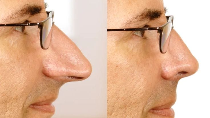 ultrasonic rhinoplasty